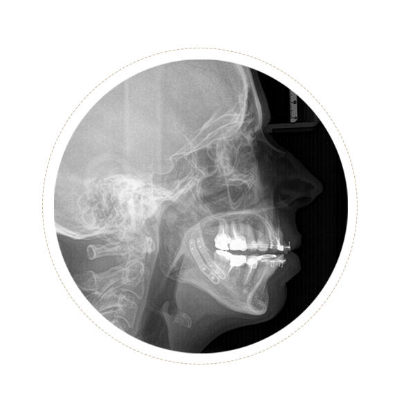 Ostéotomies mandibulaires - Seblain